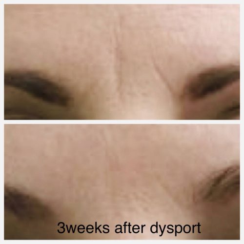 3-weeks-after-dysport