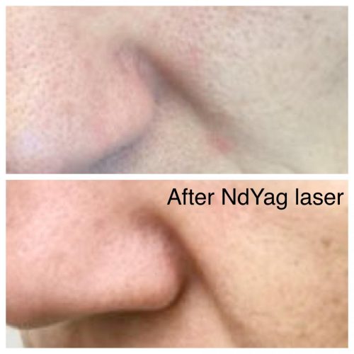 After-MDYag-Laser